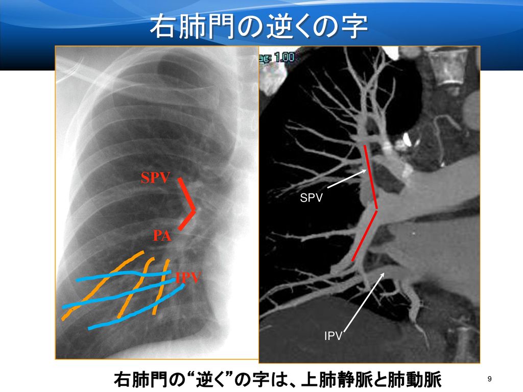 右肺門の 逆く の字は、上肺静脈と肺動脈