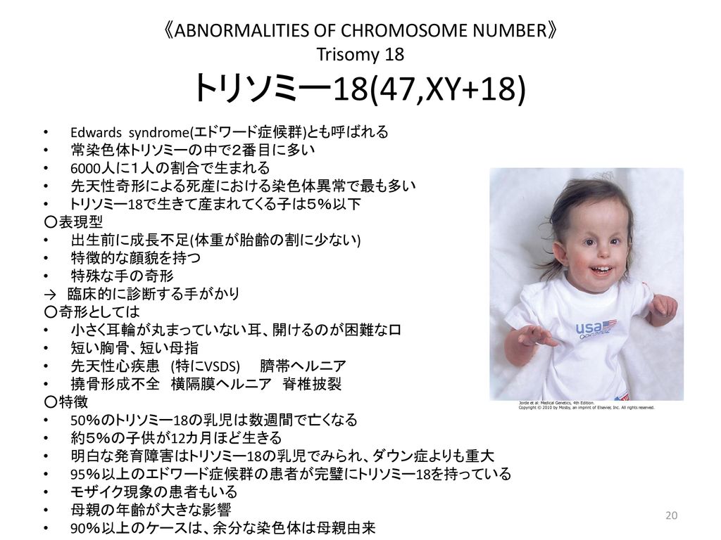 《ABNORMALITIES OF CHROMOSOME NUMBER》 Trisomy 18 トリソミー18(47,XY+18)