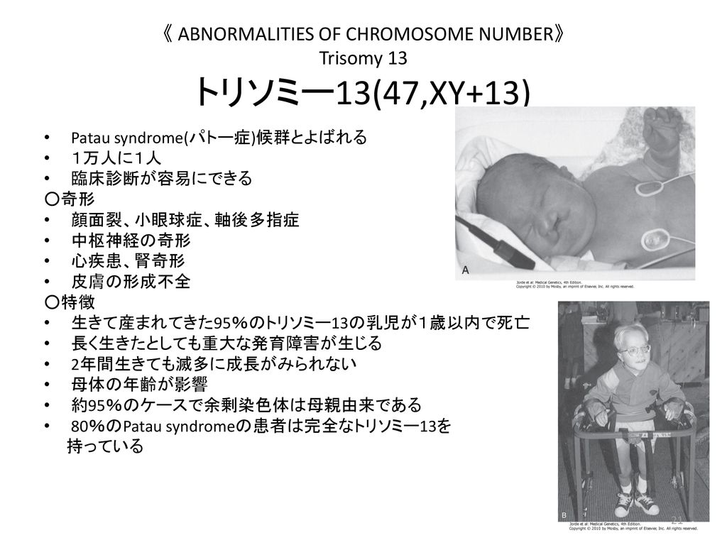 《 ABNORMALITIES OF CHROMOSOME NUMBER》 Trisomy 13 トリソミー13(47,XY+13)